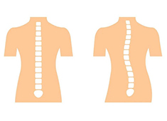 脊柱側(cè)彎的測(cè)量方法以及判定標(biāo)準(zhǔn)解讀