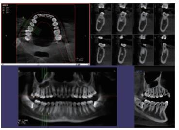 口腔CBCT 三維重建任意斷層