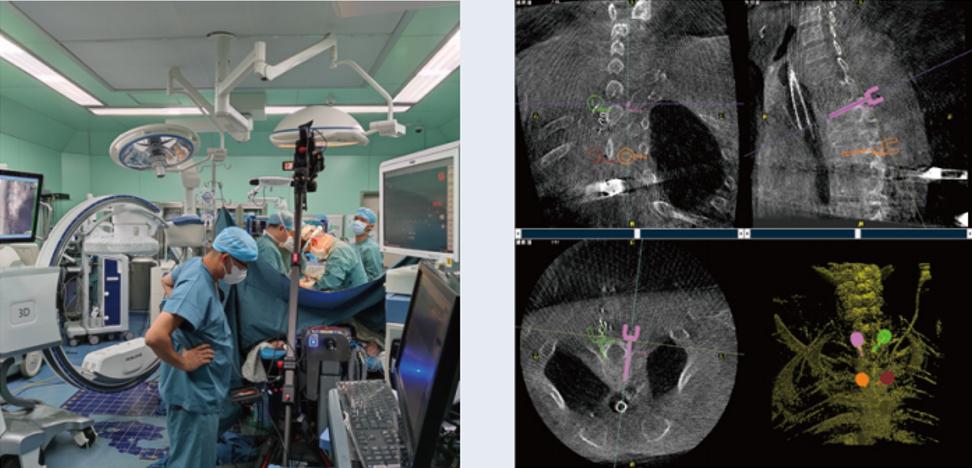 術(shù)中三維C形臂影像在脊柱導(dǎo)航機(jī)器人系統(tǒng)中的應(yīng)用
