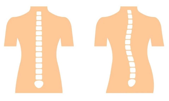 正常脊柱和脊柱側彎的對比